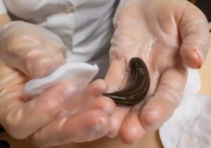 Leech Therapy